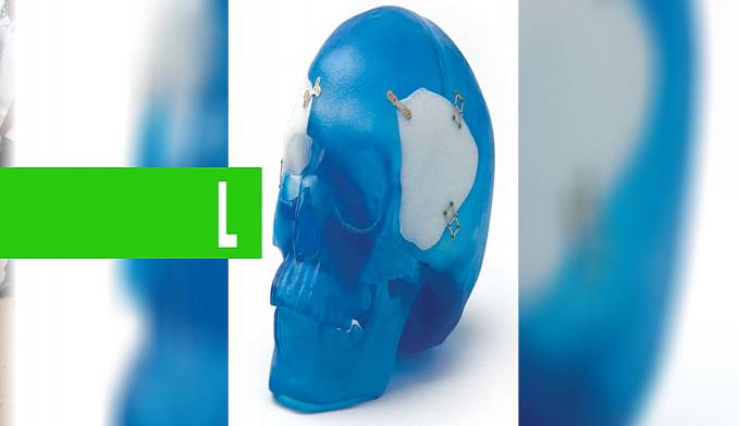 FIOCRUZ DESENVOLVE TECNOLOGIA PARA RECONSTRUÇÃO CRANIANA - News Rondônia