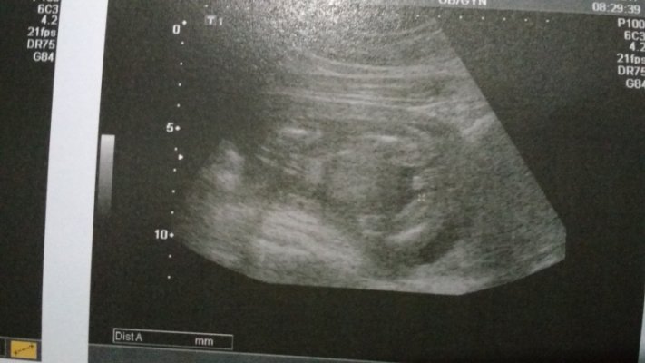 ERRO GROTESCO: MÉDICOS ERRAM SEXO E FAMÍLIA REGISTRA MENINO COMO MENINA - News Rondônia