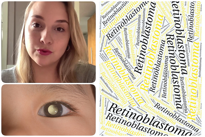 Oftalmopediatra explica o que é Retinoblastoma, câncer ocular que afeta Lua, filha de Tiago Leifert - News Rondônia