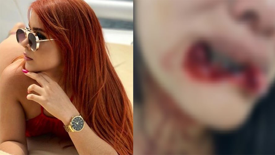 BLOGUEIRA ARRANCA LÁBIO DE MULHER DURANTE BRIGA EM MANAUS - News Rondônia