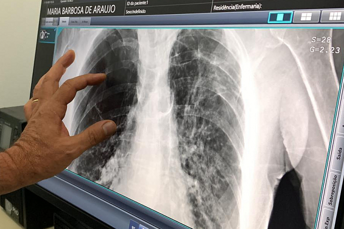 CREDENCIAMENTO - Aberto Chamamento Público para credenciar empresas que prestam serviços de radiodiagnóstico, tomografia e ressonância magnética - News Rondônia