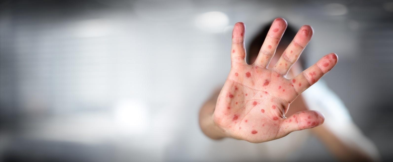SEM REGISTRO EM RO, MINISTÉRIO VAI ENVIAR 15 MIL DOSES EXTRA DA VACINA CONTRA SARAMPO - News Rondônia
