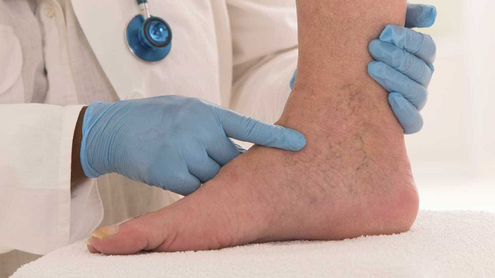 VARIZES: SAIBA COMO TRATÁ-LAS PARA NÃO TER SÉRIAS COMPLICAÇÕES - News Rondônia