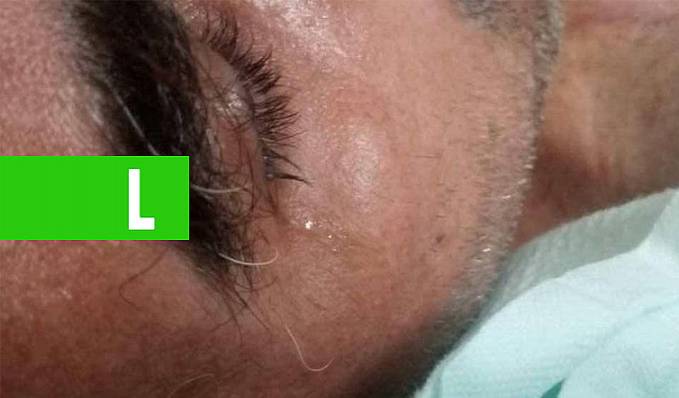 Internado há seis meses e implorando por cirurgia, morador de Colorado do Oeste está ficando com o corpo 'em carne viva' - News Rondônia