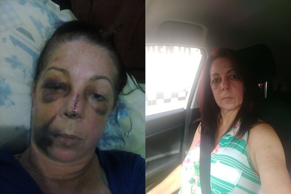 Mulher fica com rosto desfigurado após abordagem de policial militar - News Rondônia