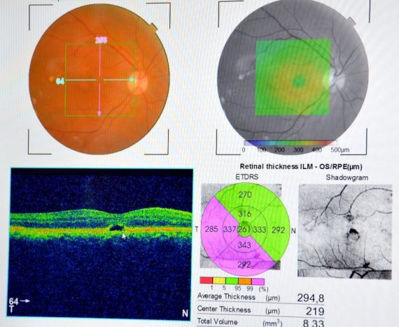 EXAME DE ALTA COMPLEXIDADE AJUDAM NO DIAGNÓSTICO E CONTROLE DA DEGENERAÇÃO MACULAR EM RONDÔNIA - News Rondônia