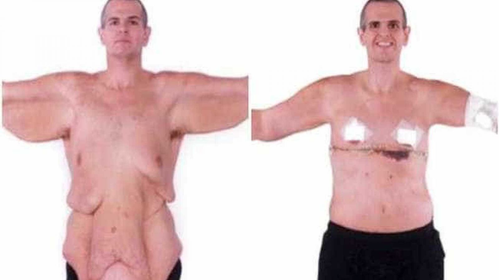 IMPRESSIONANTE: HOMEM PERDE 200 KG E FAZ CIRURGIA PARA RETIRADA DE PELE - News Rondônia