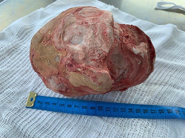 HOMEM DE 51 ANOS TEM PEDRA DE 1,3KG E 18CM RETIRADA DA BEXIGA - News Rondônia