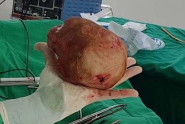 HOMEM DE 51 ANOS TEM PEDRA DE 1,3KG E 18CM RETIRADA DA BEXIGA - News Rondônia