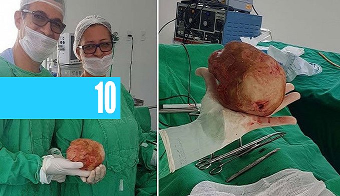 HOMEM DE 51 ANOS TEM PEDRA DE 1,3KG E 18CM RETIRADA DA BEXIGA - News Rondônia