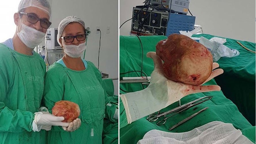 HOMEM DE 51 ANOS TEM PEDRA DE 1,3KG E 18CM RETIRADA DA BEXIGA - News Rondônia
