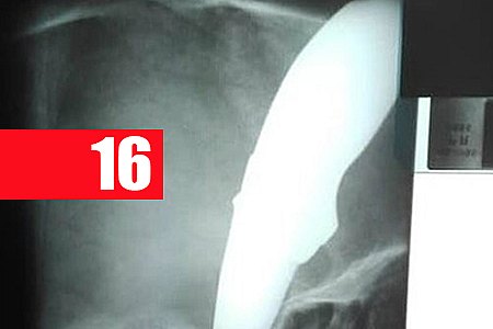 APÓS RECEBER FACADA NA CABEÇA, CICLISTA PEDALA EM BUSCA DE AJUDA - IMAGEM FORTE - News Rondônia