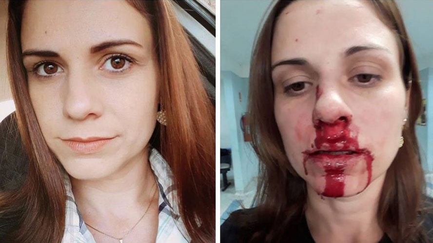 MULHER DENUNCIA EX-MARIDO APÓS LEVAR SOCO NO NARIZ - News Rondônia