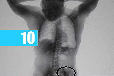 RAIO-X MOSTRA ALIANÇAS ENGOLIDAS POR LADRÃO; JOIAS SÃO DEVOLVIDAS - News Rondônia