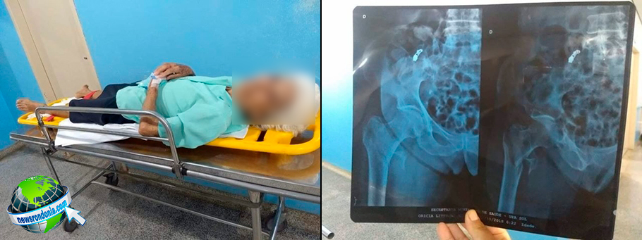 IDOSA DE 80 ANOS QUEBRA A PERNA AO SER ATROPELADA E FAMÍLIA PRECISA PAGAR AMBULÂNCIA PARA TRANSFERÊNCIA AO JOÃO PAULO II - News Rondônia