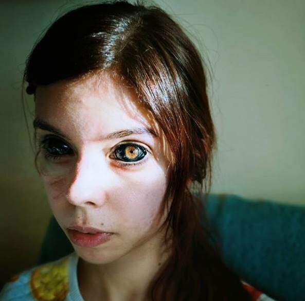 MÁ IDEIA: JOVEM DE 25 ANOS FICA CEGA APÓS TENTAR TATUAR OS OLHOS DE PRETO - News Rondônia