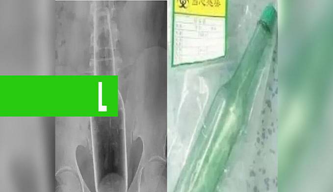 INUSITADO: HOMEM VAI AO HOSPITAL TIRAR GARRAFA DO RETO E ALEGA QUE SÓ ESTAVA TENTANDO COÇAR AS COSTAS - News Rondônia