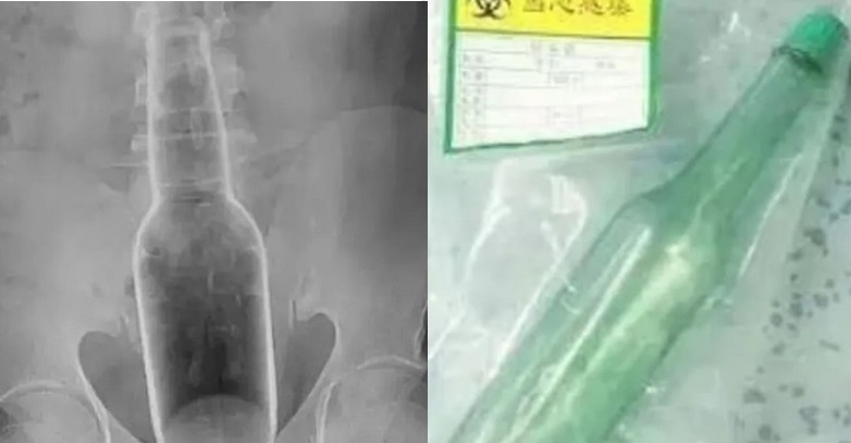 INUSITADO: HOMEM VAI AO HOSPITAL TIRAR GARRAFA DO RETO E ALEGA QUE SÓ ESTAVA TENTANDO COÇAR AS COSTAS - News Rondônia