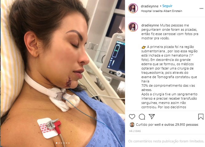 Médica atacada por cobra mostra picadas e relata luta por sobrevivência - News Rondônia
