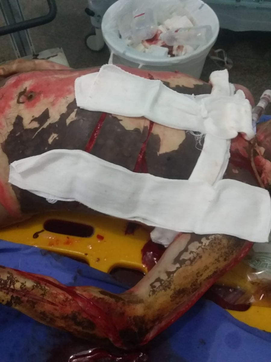 ORGULHO DO MADEIRA: HOMEM É SOCORRIDO EM ESTADO GRAVE APÓS TER CORPO QUEIMADO EM INCÊNDIO - (IMAGENS FORTES) - News Rondônia