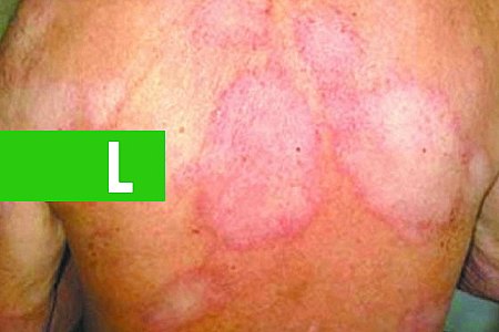 DIAGNÓSTICO E TRATAMENTO PRECOCE DA HANSENÍASE DIFICULTA PROLIFERAÇÃO DE DOENÇA INFECTOCONTAGIOSA EM RONDÔNIA - News Rondônia