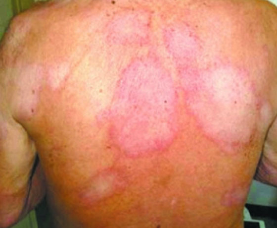 DIAGNÓSTICO E TRATAMENTO PRECOCE DA HANSENÍASE DIFICULTA PROLIFERAÇÃO DE DOENÇA INFECTOCONTAGIOSA EM RONDÔNIA - News Rondônia