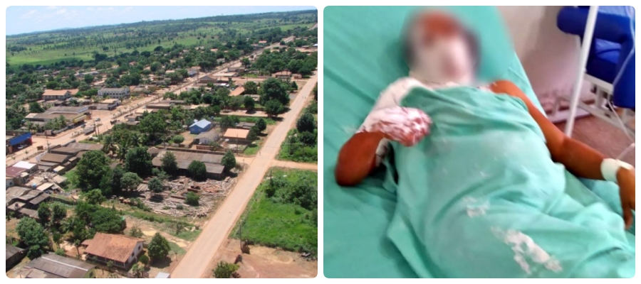 Mulher que teve o corpo queimado pelo filho continua internada no Vale do Anari; homem nega e diz que a garrafa com álcool explodiu - News Rondônia