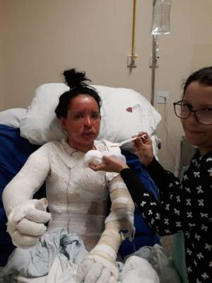 UNIVERSITÁRIA DE VILHENA ESTÁ EM COMA EM CIDADE DO MATO GROSSO, APÓS TER CORPO QUEIMADO DURANTE CHURRASCO - News Rondônia
