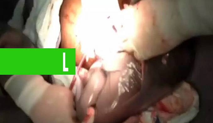 CASO RARO: BEBÊ NASCE DENTRO DE SACO AMNIÓTICO EM SÃO PAULO - News Rondônia