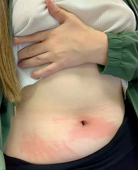 ALERGIA À ÁGUA FAZ ESTUDANTE TOMAR BANHO APENAS DUAS VEZES POR MÊS - News Rondônia