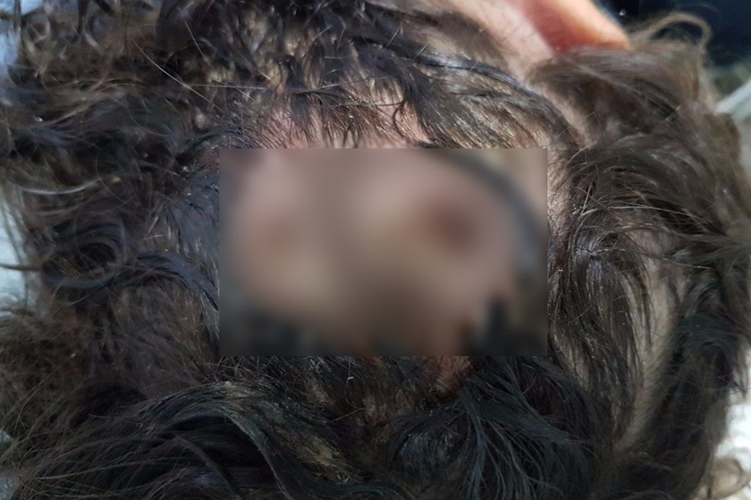 MÃE DE MENINA COM LARVAS NA CABEÇA ESTÁ COM MEDO DE SER LINCHADA - News Rondônia