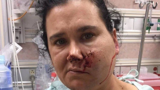 MÃE FICA COM FLECHA CRAVADA NO ROSTO AO SALVAR FILHO DURANTE BRIGA - News Rondônia