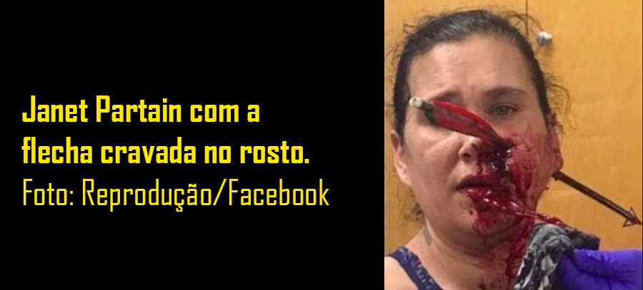 MÃE FICA COM FLECHA CRAVADA NO ROSTO AO SALVAR FILHO DURANTE BRIGA - News Rondônia