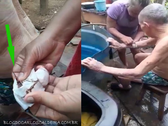 URGENTE - ESQUECERAM UMA AGULHA NO BRAÇO DE IDOSO DE MAIS DE 80 ANOS - News Rondônia