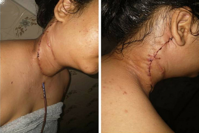 Adolescente de Cerejeiras que extraiu 28 nódulos após câncer no pescoço vende rifas e pede ajuda para tratamento - News Rondônia