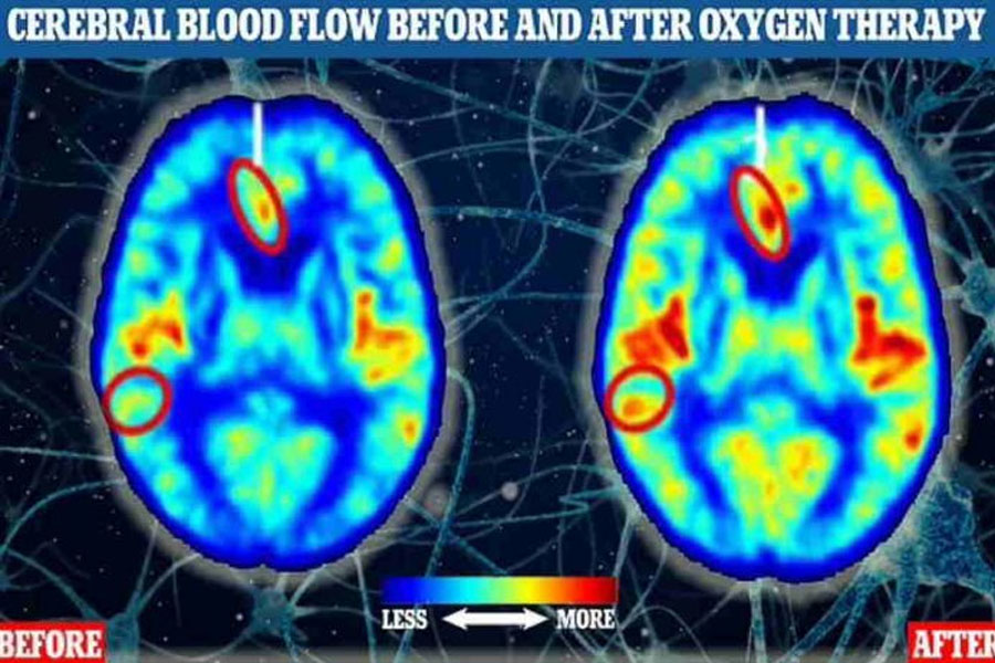 Alzheimer pode ser revertido com câmaras de oxigênio - News Rondônia