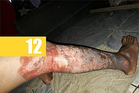 DIA DO EVANGÉLICO - TIO E SOBRINHO FICAM GRAVEMENTE FERIDOS APÓS INCÊNDIO EM CARRINHO DE CACHORRO QUENTE - News Rondônia