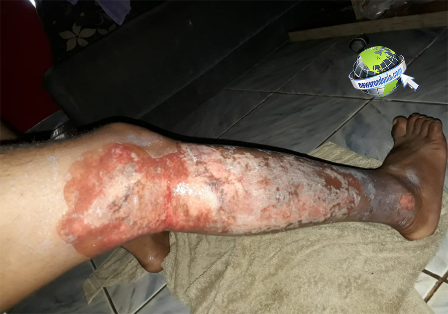 DIA DO EVANGÉLICO - TIO E SOBRINHO FICAM GRAVEMENTE FERIDOS APÓS INCÊNDIO EM CARRINHO DE CACHORRO QUENTE - News Rondônia