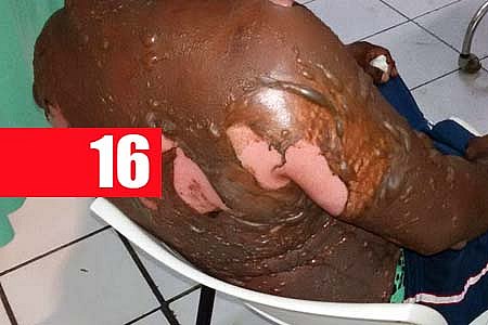 COZIDÃO - ESPOSA FOGE APÓS TENTAR MATAR MARIDO COM ÁGUA FERVENTE - News Rondônia