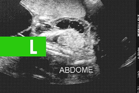 UM ABORTO A CADA QUATRO GRÁVIDAS - News Rondônia