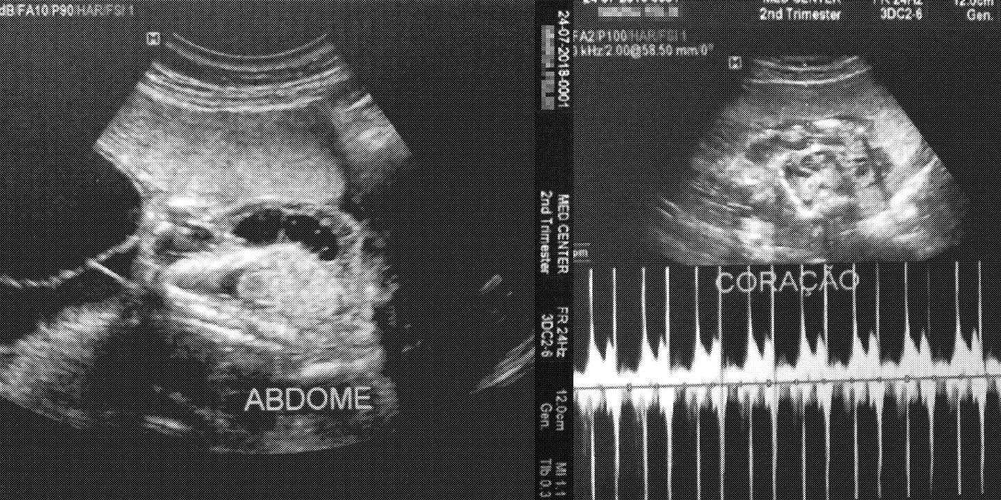 UM ABORTO A CADA QUATRO GRÁVIDAS - News Rondônia