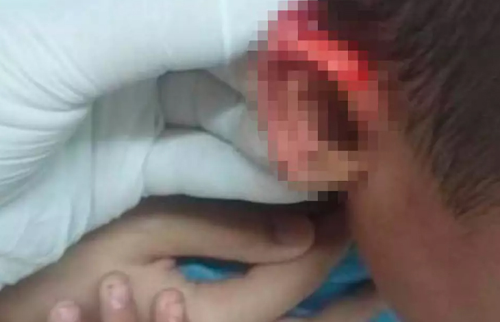 MENINO DE TRÊS ANOS TEM ORELHA CORTADA COM TESOURA EM CRECHE - News Rondônia