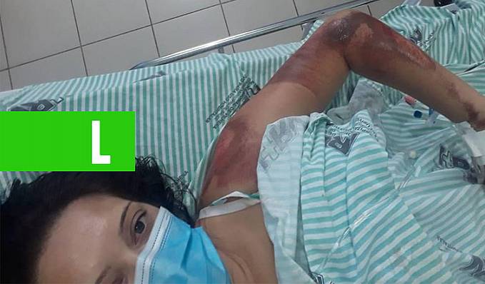 Técnica em enfermagem fica toda ralada e fratura cinco costelas por causa de quebra-molas mal sinalizado em rodovia - News Rondônia