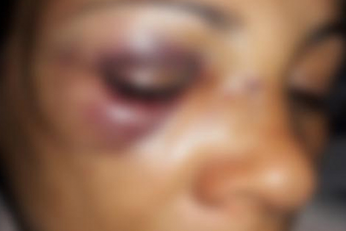 DEFORMADO - Marido é preso após esmurrar rosto da esposa - News Rondônia