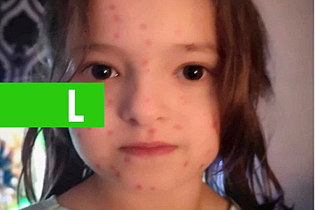 MENINA DE 6 ANOS DESENHA CATAPORA POR TODO CORPO NA TENTATIVA DE NÃO IR PARA A ESCOLA - News Rondônia