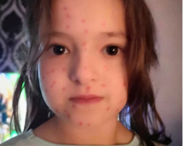 MENINA DE 6 ANOS DESENHA CATAPORA POR TODO CORPO NA TENTATIVA DE NÃO IR PARA A ESCOLA - News Rondônia