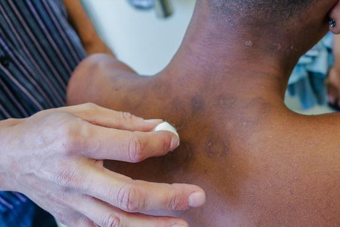 Janeiro Roxo alerta para a conscientização sobre a hanseníase - News Rondônia