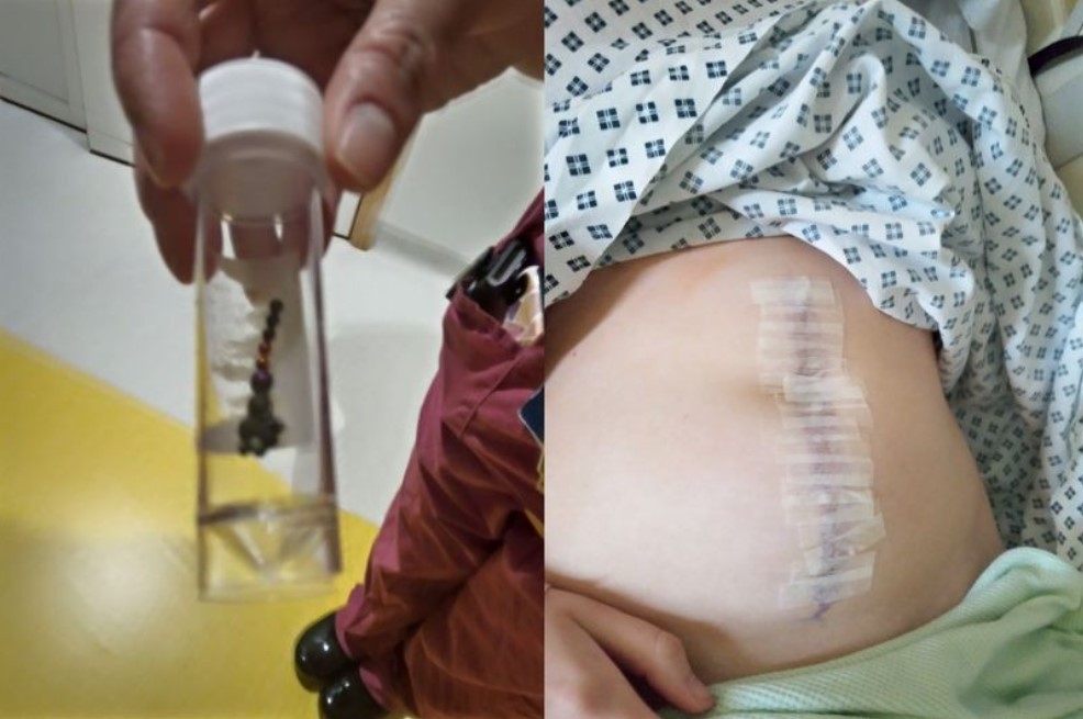 Jovem perde parte do intestino e apêndice ao tentar participar de desafio do TikTok - News Rondônia