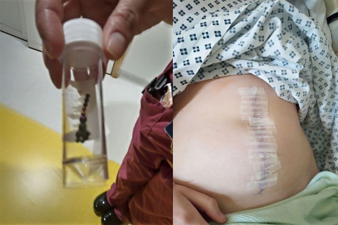 Jovem perde parte do intestino e apêndice ao tentar participar de desafio do TikTok - News Rondônia