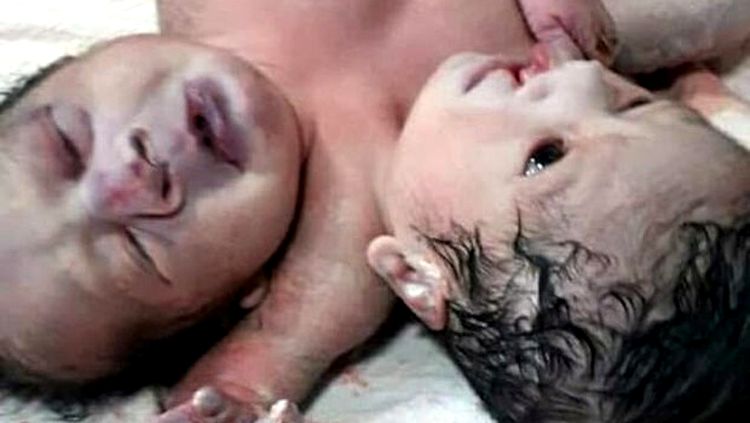 CASO RARÍSSIMO : COM DUAS CABEÇAS E TRÊS BRAÇOS, NASCE BEBÊS SIAMESES - News Rondônia